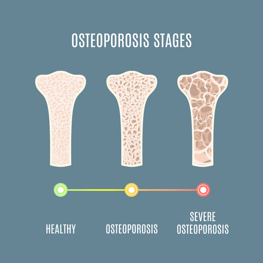 Weight Training, Bone Health and Injury